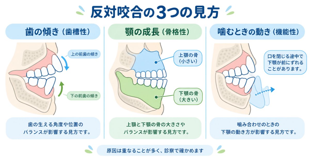 子どもの前歯が反対に噛み合うのはなぜ?